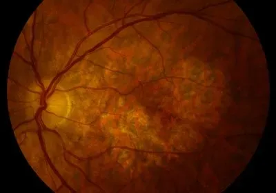close-up of a retina showing blood vessels and a damaged spot